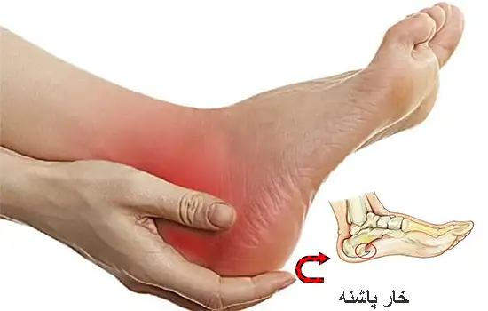 درمان خارپاشنه